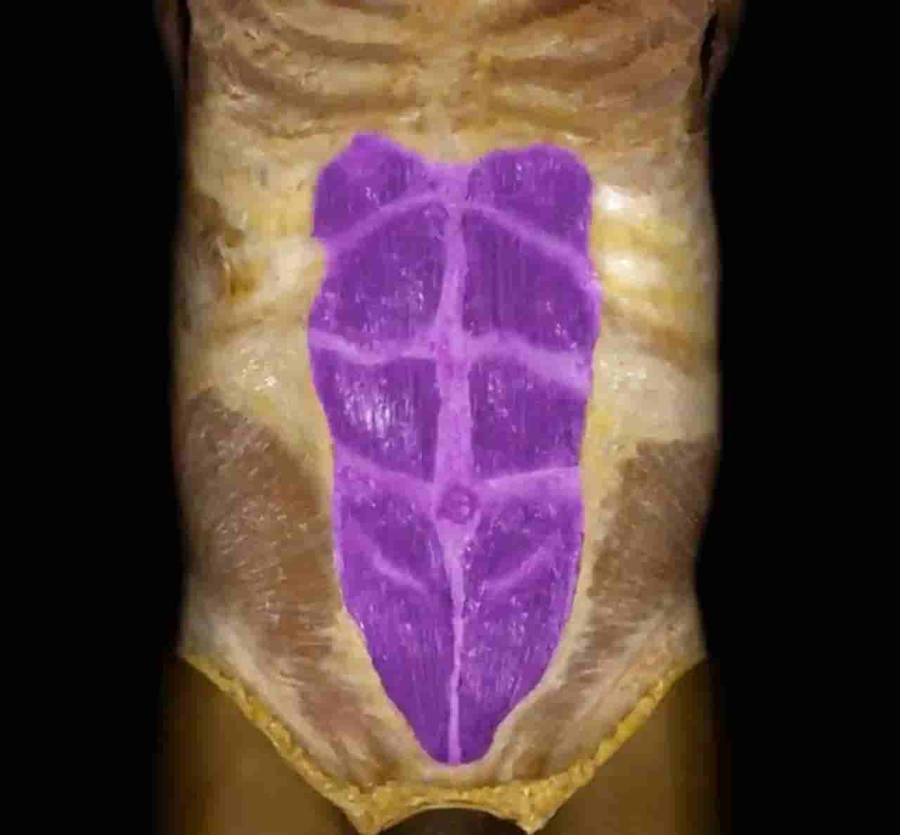 Cadaver dissection of the rectus abdominis 