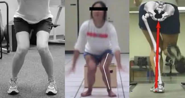 3 Images of individuals with a functional knee valgus - excessive femoral internal rotation and adduction.