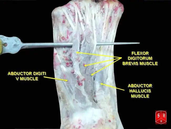 Cadeveric dissection of the plantar aspect of the foot, including labeling of commonly under-active muscles, abductor hallucis, abductor digiti and flexor digitorum brevis - By Anatomist90 - Own work, CC BY-SA 3.0, https://commons.wikimedia.org/w/index.php?curid=17421240