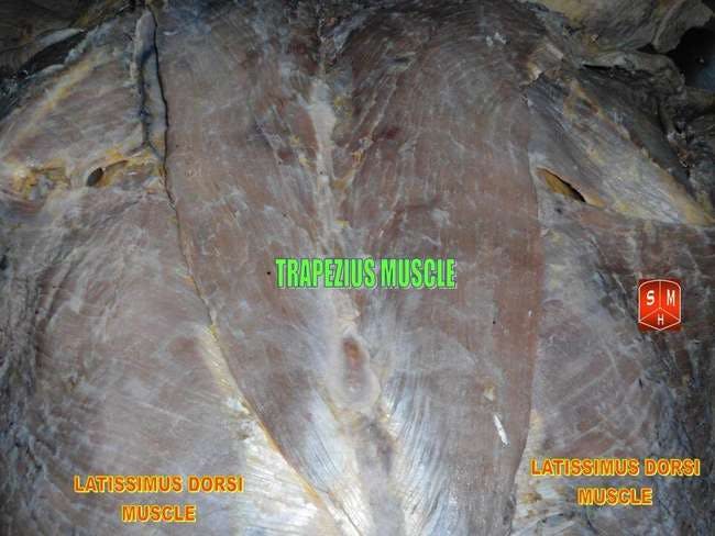 The trapezius muscle in a cadaver dissection