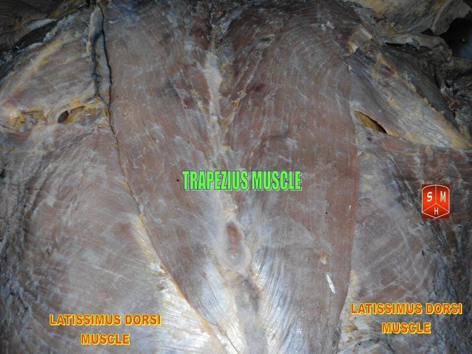 The trapezius muscle in a cadaver dissection