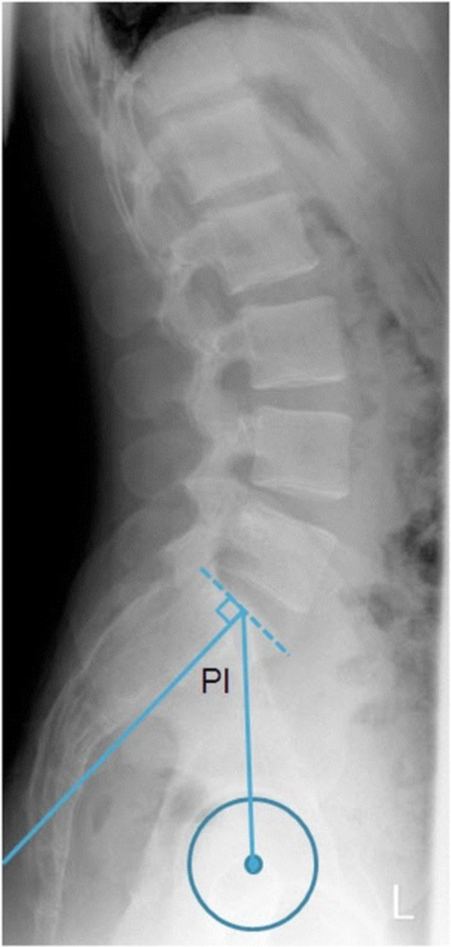 Radiological imaging lateral view of lumbar spine and pelvis with markings for pelvic incidence angle