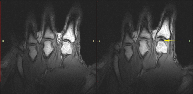 Visualization of joint cavitation (joint popping) - By © 2015 Kawchuk et al. - http://journals.plos.org/plosone/article?id=10.1371/journal.pone.0119470, CC BY 4.0, https://commons.wikimedia.org/w/index.php?curid=49089125