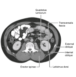 Image of a cross-section of the torso showing the erector spinae, obliques, and latissimus dorsi