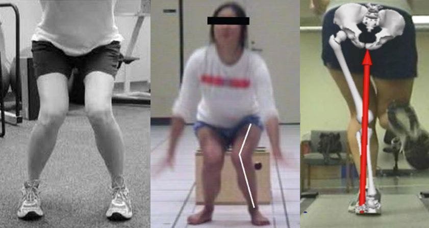 3 Images of individuals with a functional knee valgus - excessive femoral internal rotation and adduction.