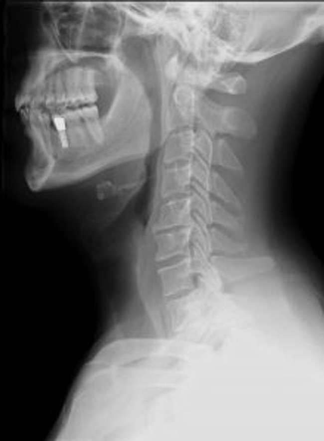 Cervical x-ray lateral view