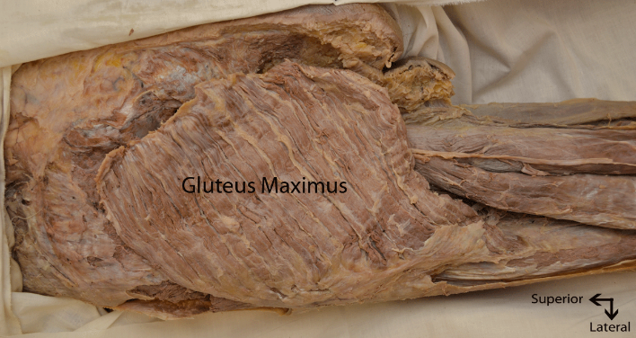 Dissection of the gluteus maximus on the posterior hip complex