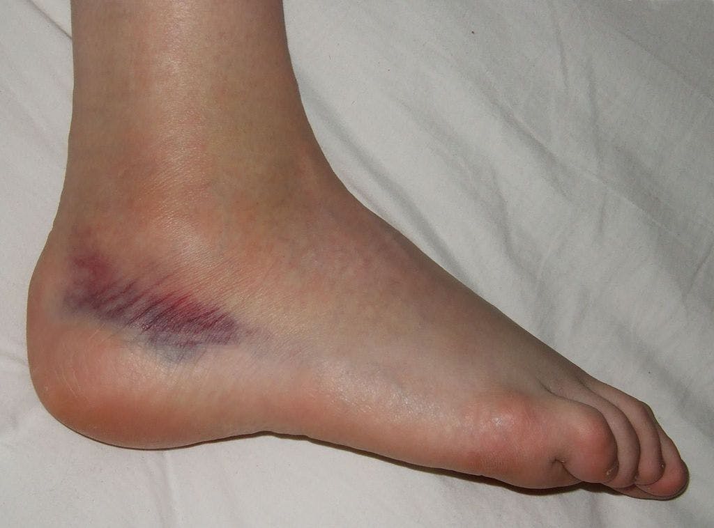 Picture of the lateral foot and ankle post inversion ankle sprain. Bruising inferior to the lateral malleolus.