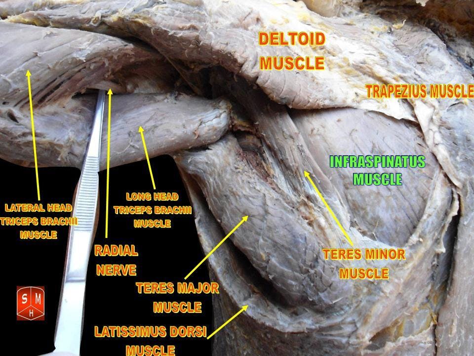 Cadaver dissection depicting a posterior view of the musculature of the shoulder with labels (infraspinatus, teres minor, teres major, trapezius, etc.)