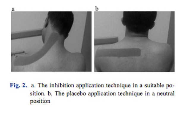 The two conditions for kinesio taping used in the current study 