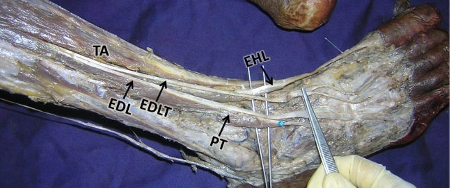 EHL, EDL, and Fibularis Tertius muscle on a cadaver