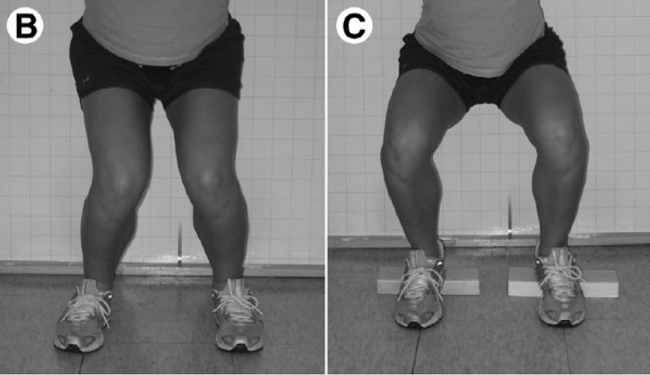 Note the blocks under the heels on the right. Indicating much of this dysfunction stems from dorsiflexion restriction. - Source: Bell et. al. 2008 - http://www.somastruct.com/wp-content/uploads/2013/04/kneevalgussquat-600x346.jpg