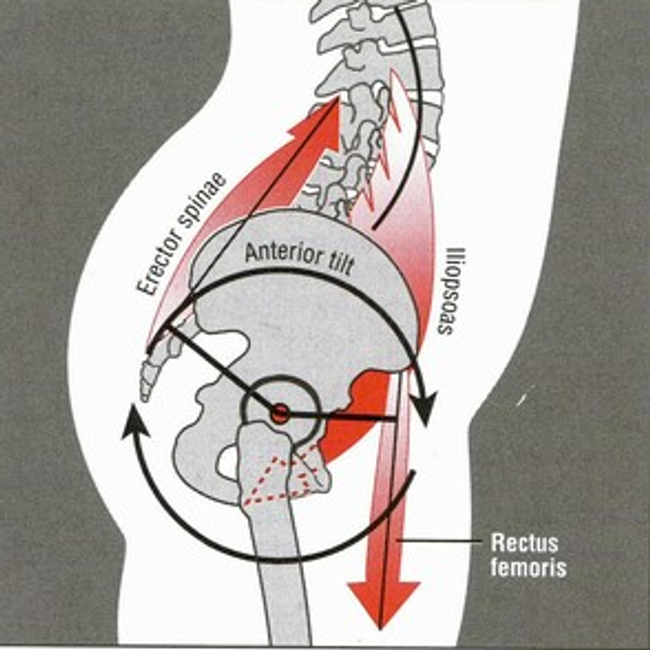 Forces contributing to an anterior pelvic tilt - Donald A. Neumann, “Kinesiology of the Musculoskeletal System: Foundations of Rehabilitation – 2nd Edition” © 2012 Mosby, Inc.