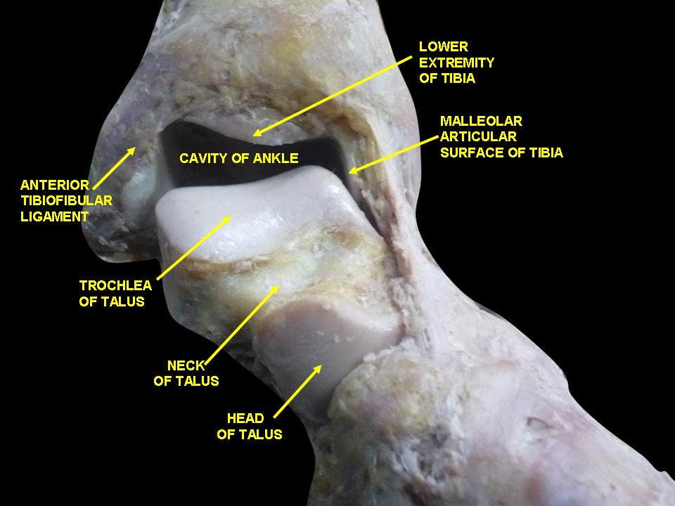 Cadaver Dissection, soft tissue removed of the anterior ankle. Mortise, malleoli, head of talus and neck of talus clearly labeled.