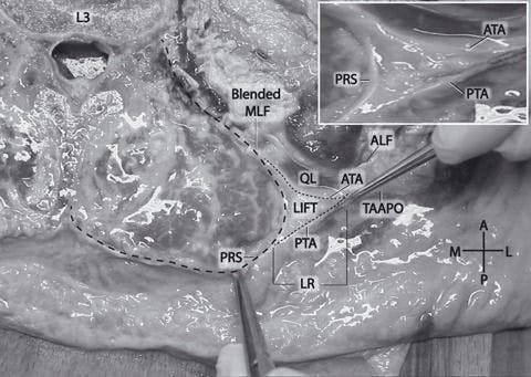 Figure 2: A comparatively large lumbar interfascial triangle (LIFT) at the L3 vertebral level. Note the fatty composition of the LIFT. The right pincer is pulling the junction of the anterior and posterior laminae of the TA aponeurosis (small dashed outline). The left pincer is pulling on the PRS (large dashed outline). Inset: magnified view of LIFT without dashed lines. ALF, anterior layer of thoracolumbar fascia (transversalis fascia); ATA, anterior lamina of TA aponeurosis; LIFT, lumbar interfascial triangle; LR, lateral raphe; MLF, middle layer of thoracolumbar fascia; PRS, paraspinal retinacular sheath; PTA, posterior lamina of TA aponeurosis; QL, quadratus lumborum; TAAPO, transversus abdominis aponeurosis.
